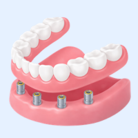 インプラントオーバーデンチャー