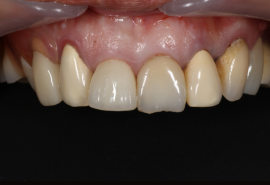 セラミック治療前
