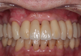 インプラント症例01後