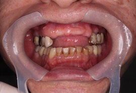 インプラント症例01前