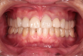 セラミック治療後