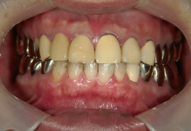 セラミック治療前