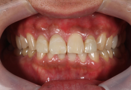フルマウス治療後
