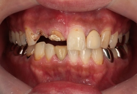 フルマウス治療前
