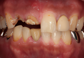 フルマウス治療前
