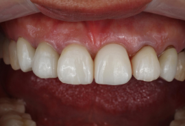 インプラント症例01後