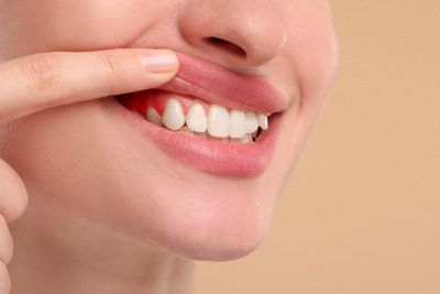 歯茎下がり（歯肉退縮）